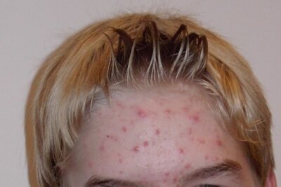 Natural Acne Skincare